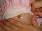 新生儿脐炎和哺乳